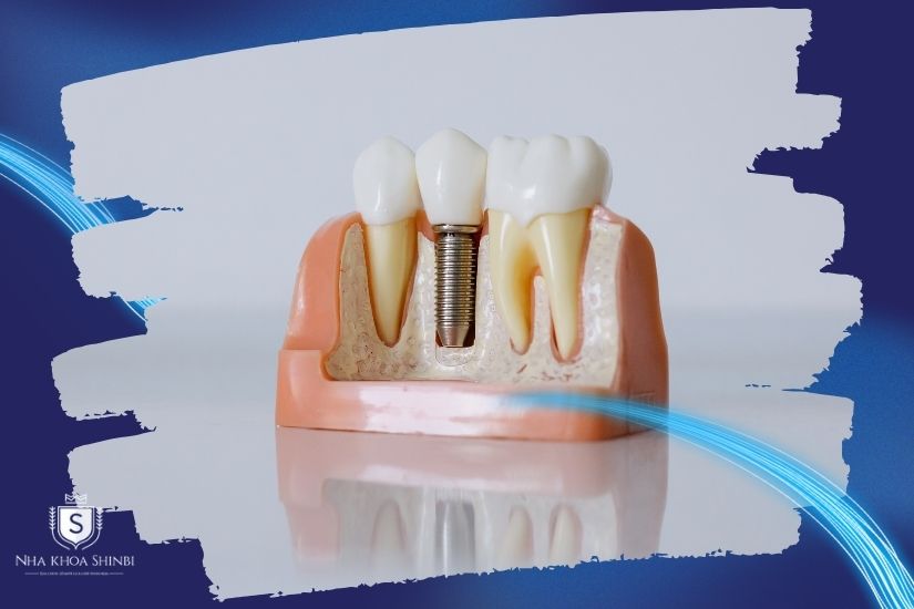 Cấy ghép Implant toàn hàm