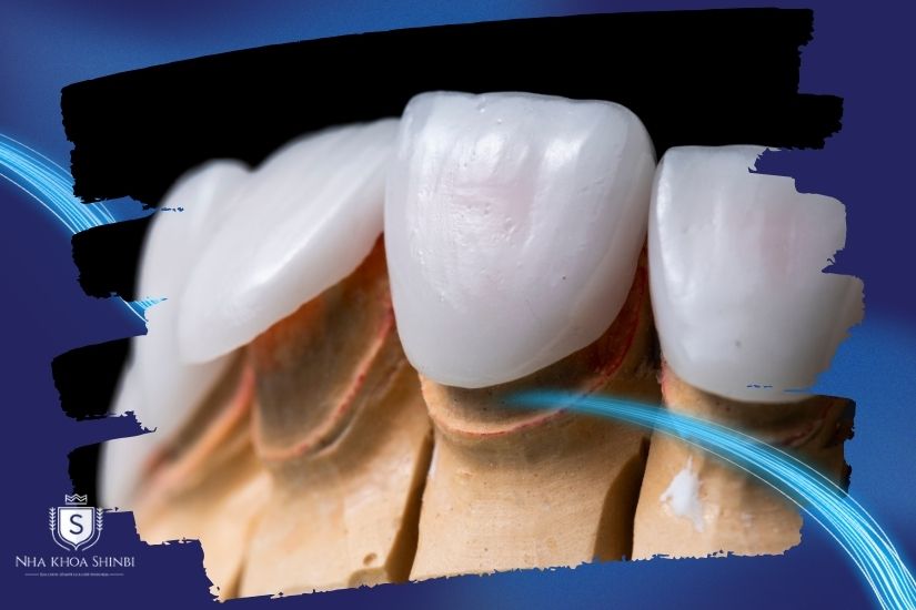 Gắn răng tạm và răng sứ vĩnh viễn