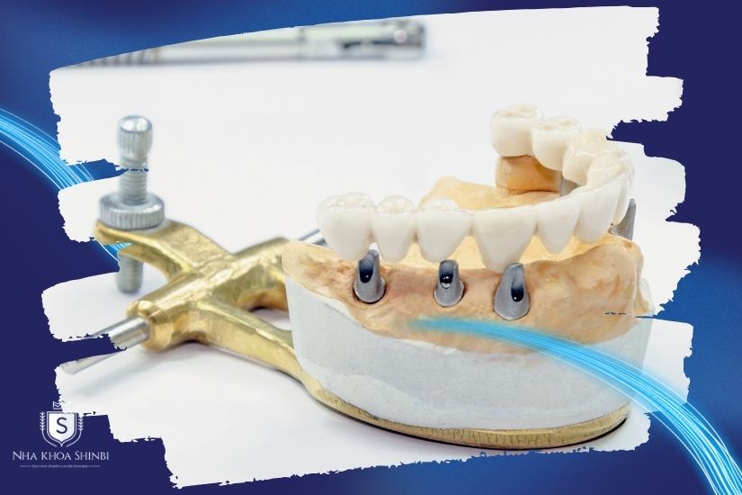 Thời gian trung bình để cấy ghép implant toàn hàm