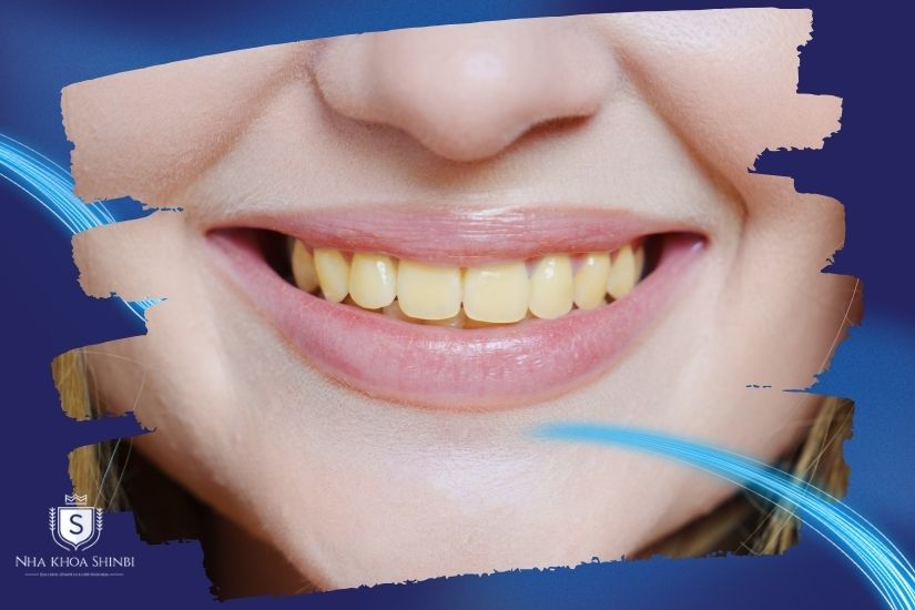 Tình trạng răng miệng hiện tại ảnh hưởng đến giá tẩy trắng răng tại phòng khám