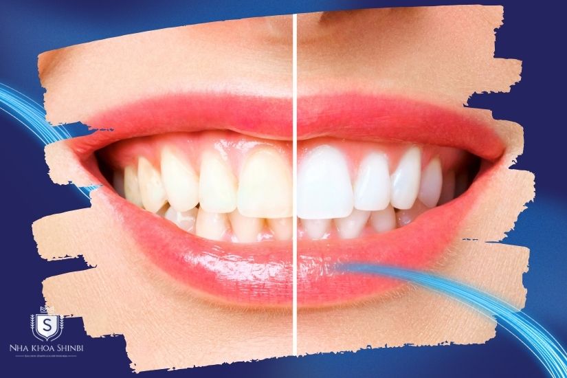 Giải đáp nên tẩy trắng ở nhà hay tại phòng khám