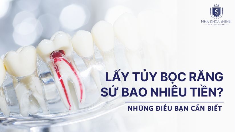 Lấy tủy bọc răng sứ bao nhiêu tiền? Những điều bạn cần biết