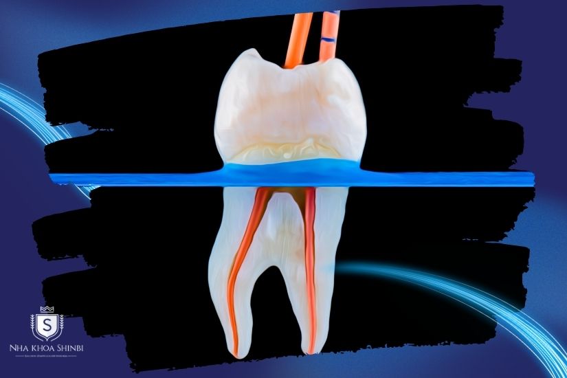 Lấy tủy bọc răng sứ