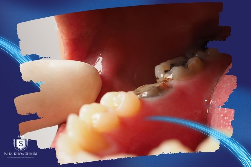 Quy trình lấy tủy bọc răng sứ