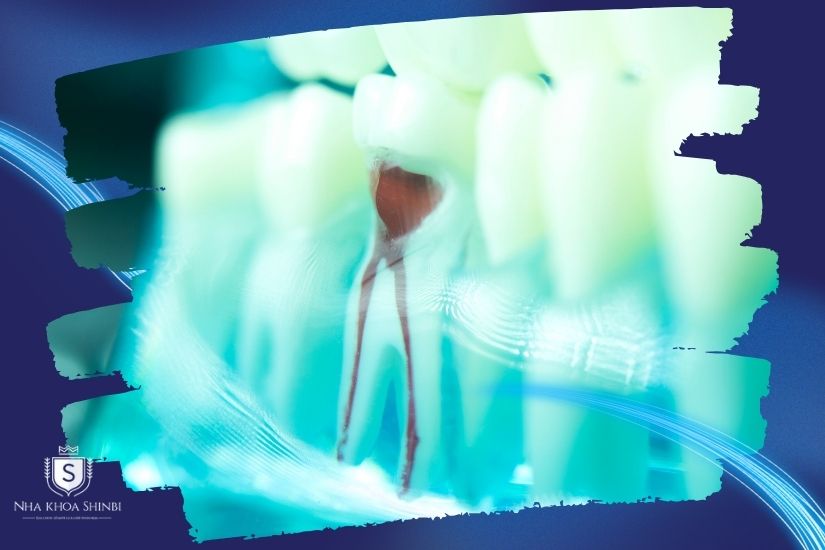 Giải mã lấy tủy bọc răng sứ bao nhiêu tiền và có nên hay không