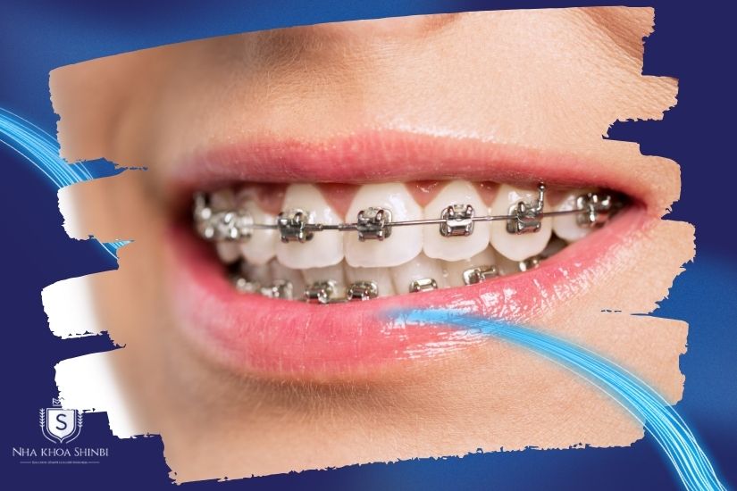 Niềng răng mắc cài kim loại