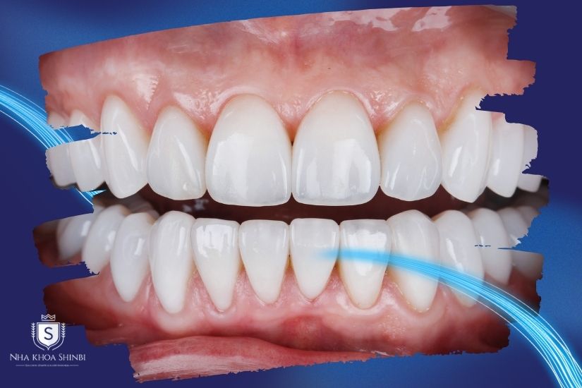 Niềng răng sứ thẩm mỹ