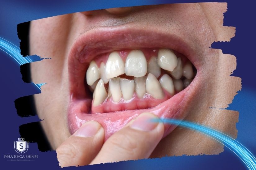 Giải mã răng khểnh có nên bọc sứ hay không