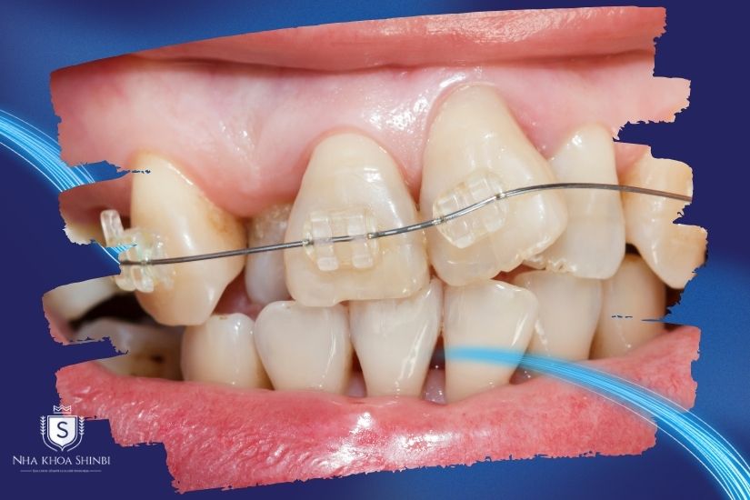 Phương pháp niền răng cho răng khểnh
