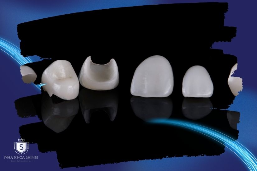 Phương pháp dán sứ Veneer 