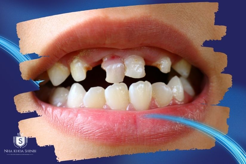 Giải mã răng lung lay có niềng được không