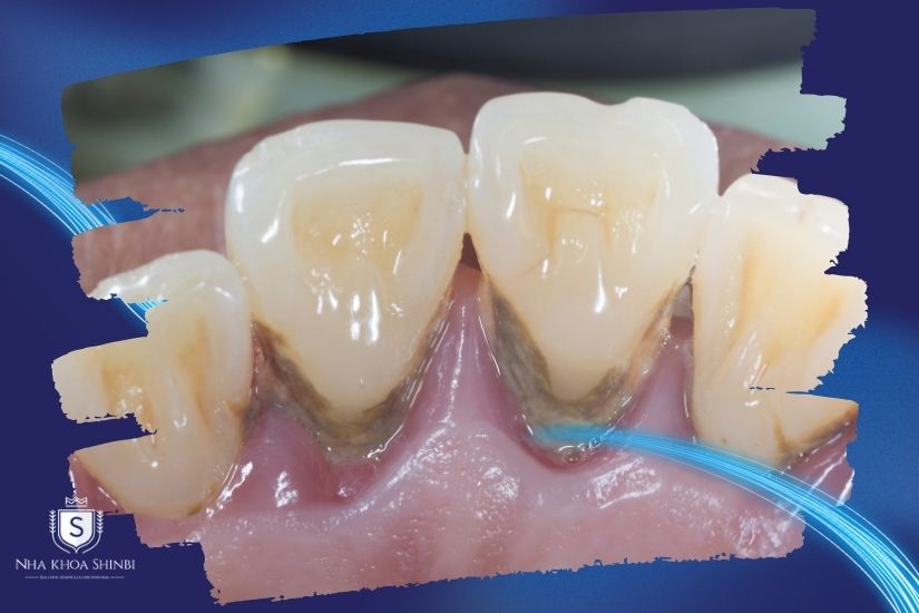 Viêm nha chu mạn tính không nên niềng răng