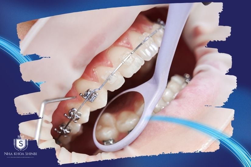 Răng lung lay có niềng được không phụ thuộc vào nhiều yếu tố