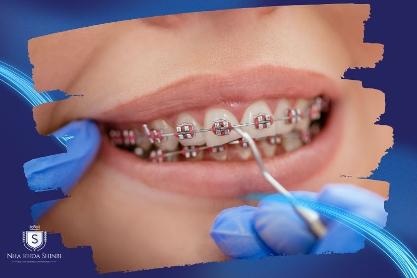Ảnh hưởng đến hiệu quả niềng