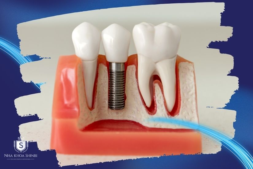 Trồng răng sứ thẩm mỹ
