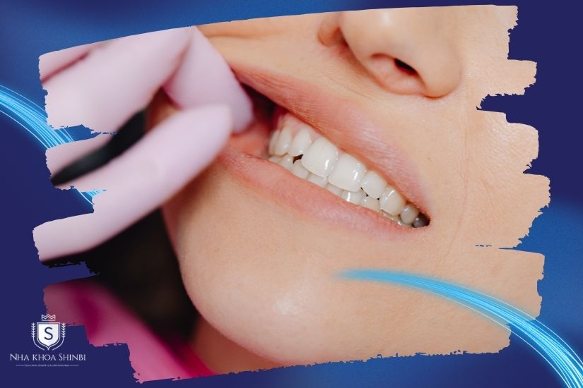 Số lượng răng cần trồng