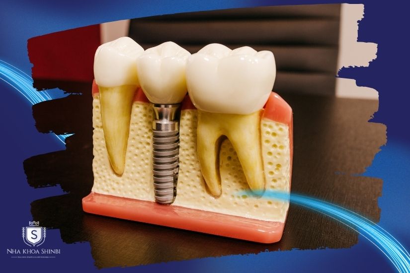 Cẩn trọng với trồng răng sứ giá rẻ