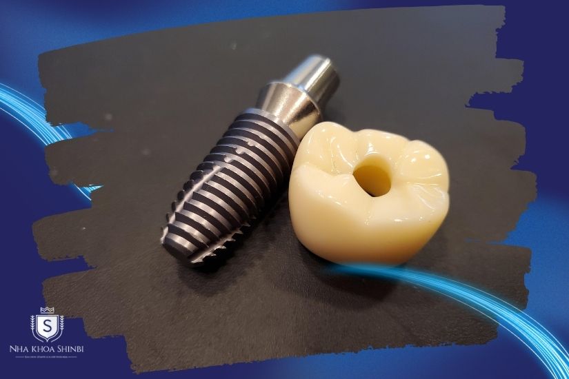 Gắn khớp nối (Abutment) và mão răng sứ