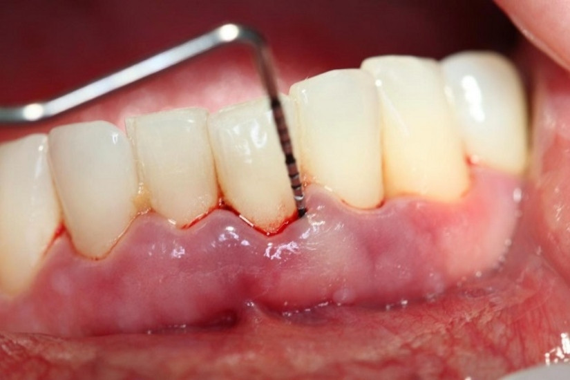 Ảnh hưởng của chu kỳ kinh khi làm răng