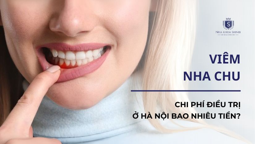 Chi phí điều trị viêm nha chu ở Hà Nội bao nhiêu tiền?