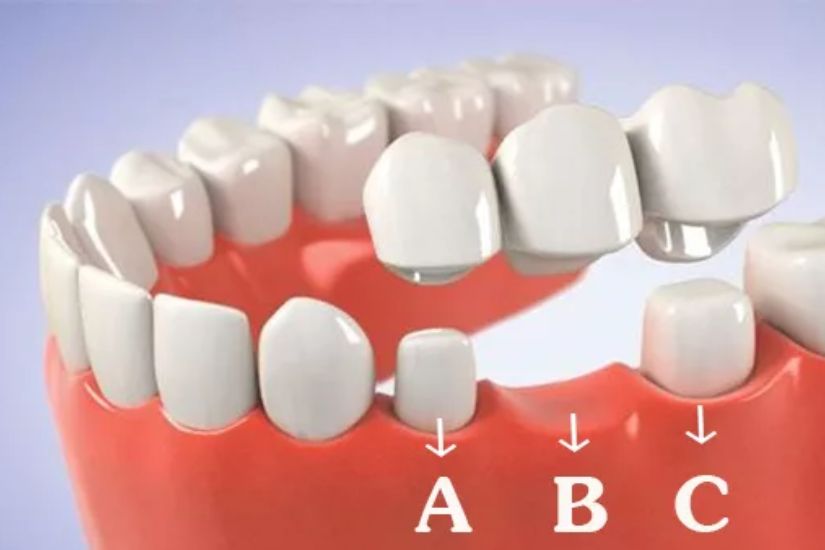Chi phí trồng răng bằng cầu răng sứ