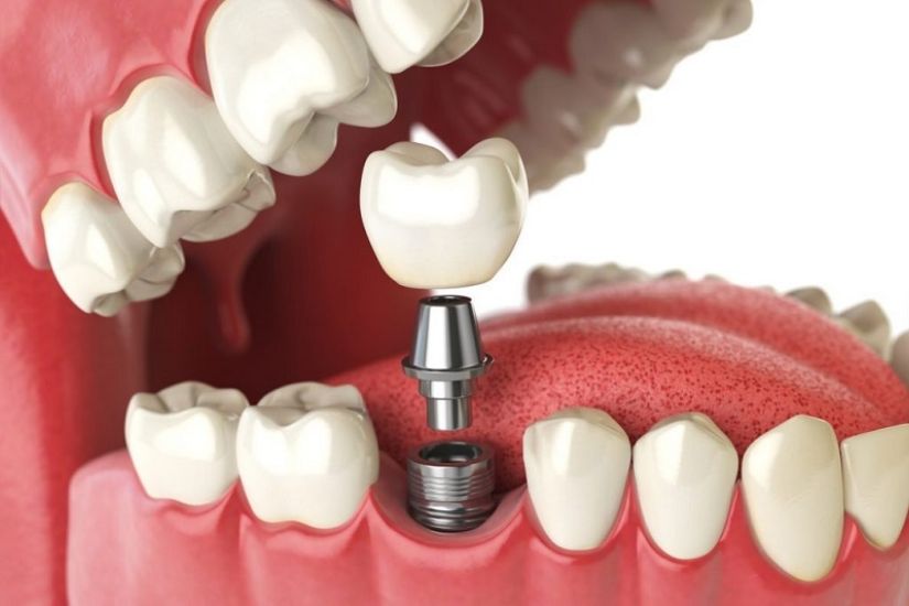 Phương pháp phục hình răng ảnh hưởng đến mức giá trồng răng