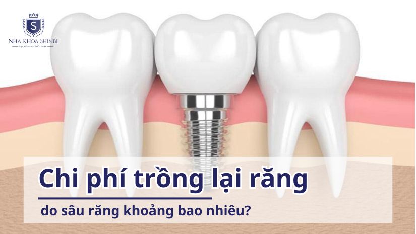 Chi phí trồng lại răng do sâu răng khoảng bao nhiêu?