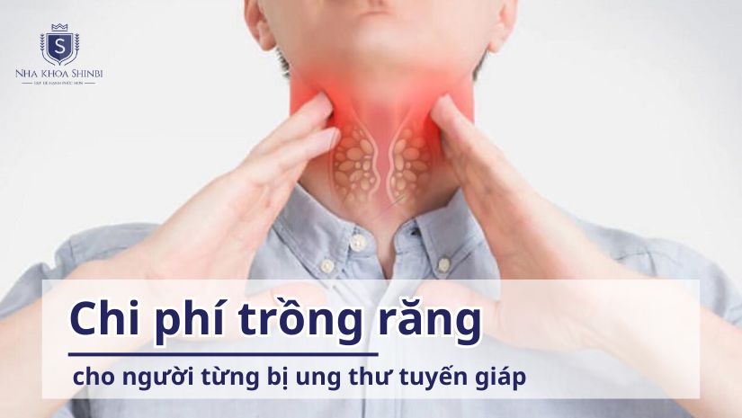 Chi phí trồng răng cho người từng bị ung thư tuyến giáp