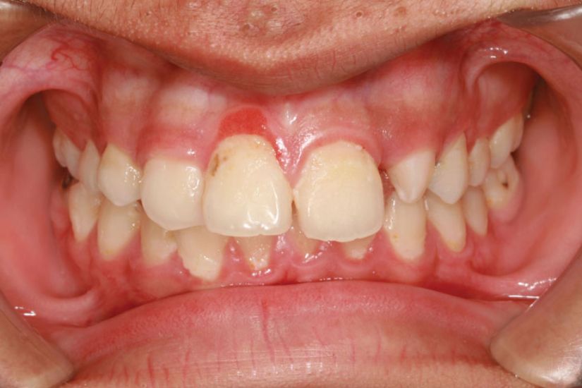 Có nên nhổ răng khi đang bị viêm lợi không?