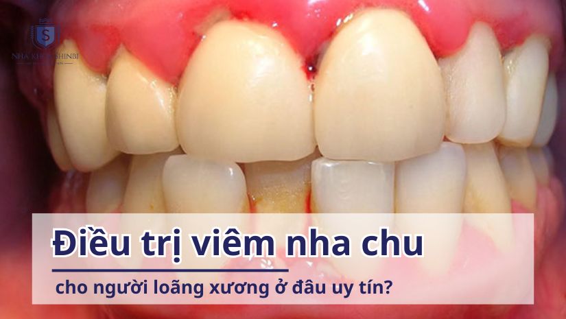 Điều trị viêm nha chu cho người loãng xương ở đâu uy tín? 