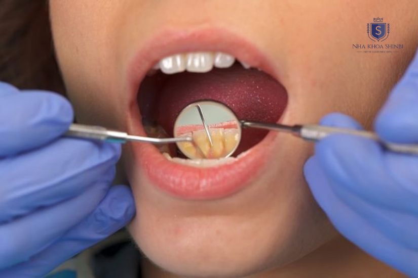Làm sạch mảng bám và vôi răng