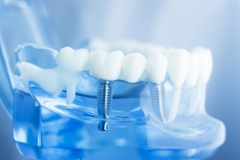 phòng khám nha khoa trồng răng cho bệnh nhân ung thư vú