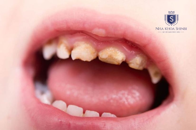 Răng sâu hoàn toàn cần nhổ bỏ