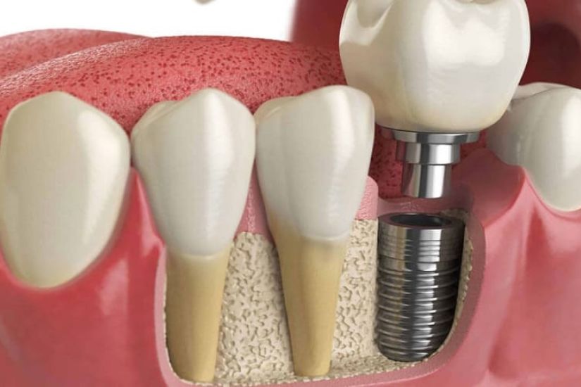 Đảm bảo điều kiện mô nướu và xương hàm ổn định