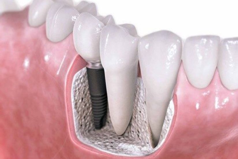 Sức khỏe răng miệng phù hợp có thể trồng răng khi đang bị viêm lợi nhẹ