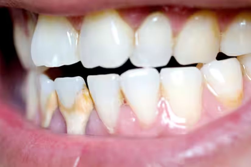 Viêm lợi thường bắt đầu từ mảng bám chứa vi khuẩn bám quanh cổ răng hoặc chân răng.