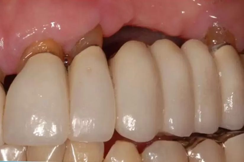 Viêm lợi gây kích ứng kéo dài và làm hỏng cấu trúc vật liệu răng giả
