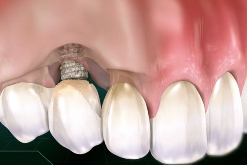Viêm quanh implant là dạng viêm lợi đặc thù, có thể phá hủy mô mềm và xương quanh trụ titan.