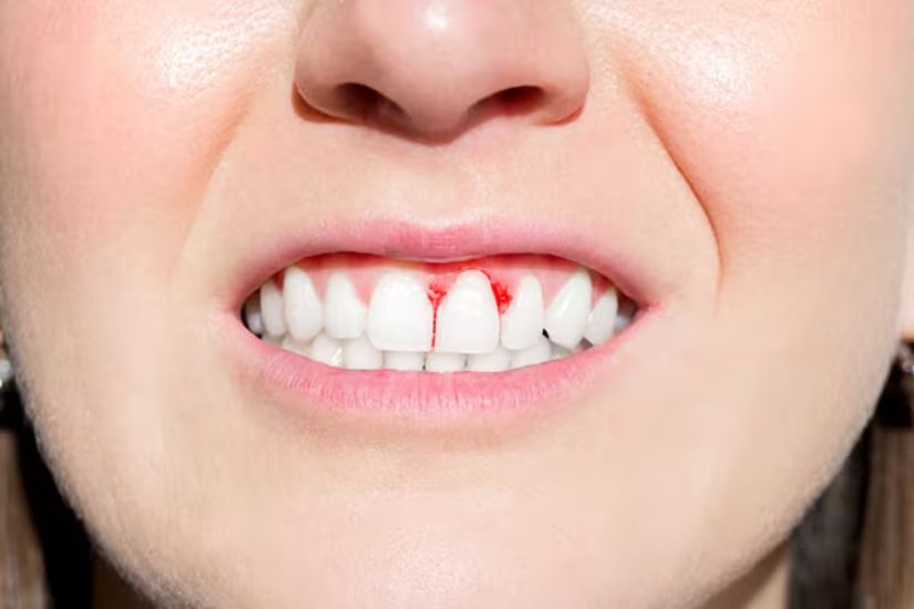Tình trạng chảy máu kéo dài và khó kiểm soát