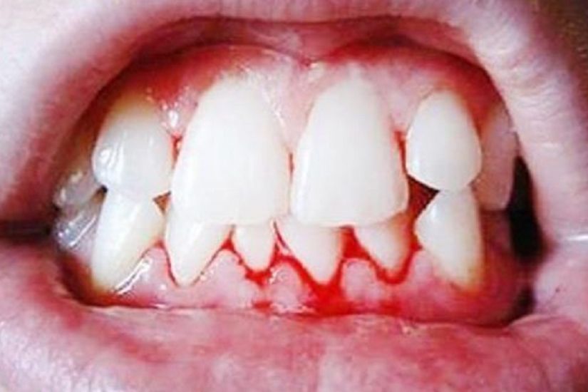 Nên trì hoãn nhổ răng khi tình trạng răng - lợi không ổn định