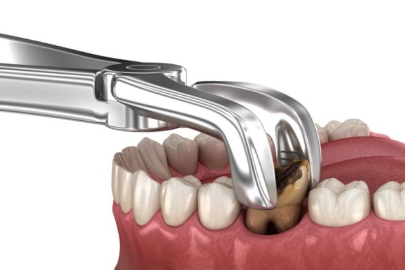 Trường hợp nào có thể nhổ răng dù bị viêm lợi?