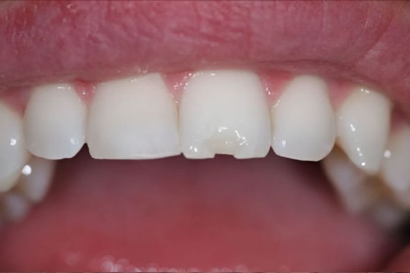 Bị nứt, vỡ, mẻ