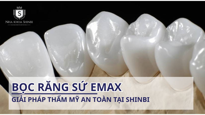 Bọc răng sứ Emax – Giải pháp thẩm mỹ an toàn tại Shinbi