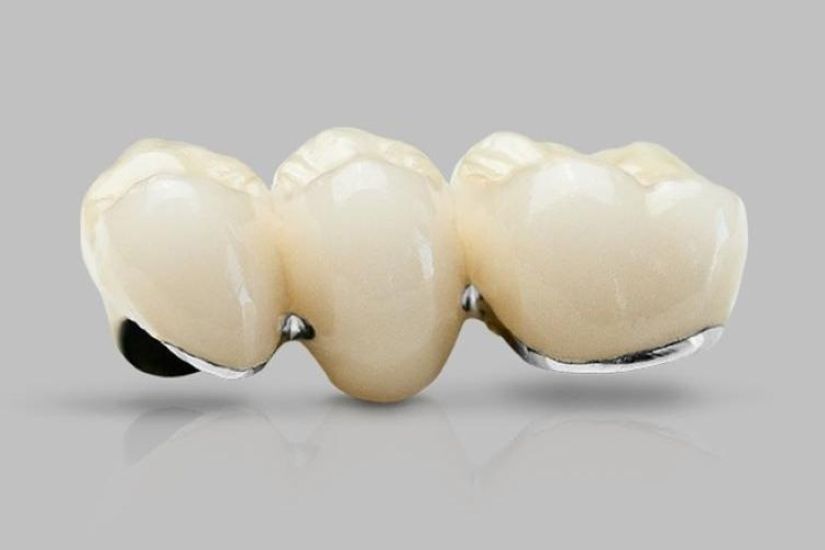 Các yếu tố ảnh hưởng tới giá răng sứ kim loại titan Các yếu tố ảnh hưởng tới giá răng sứ kim loại titan