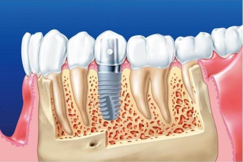 Cấy ghép răng cho người bệnh tim có rủi ro gì không?