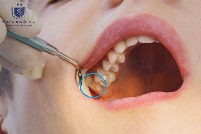 Triệu chứng mọc răng khôn hàm trên