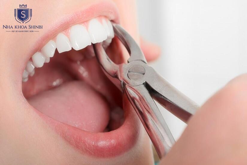 Khi nào cần nhổ răng khôn hàm trên?