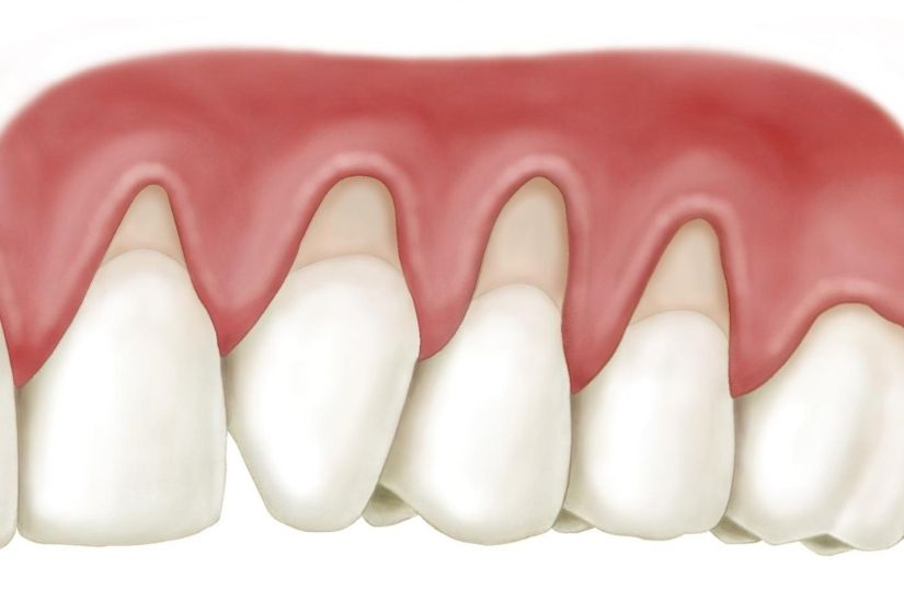 Gây viêm lợi tái phát nhiều lần