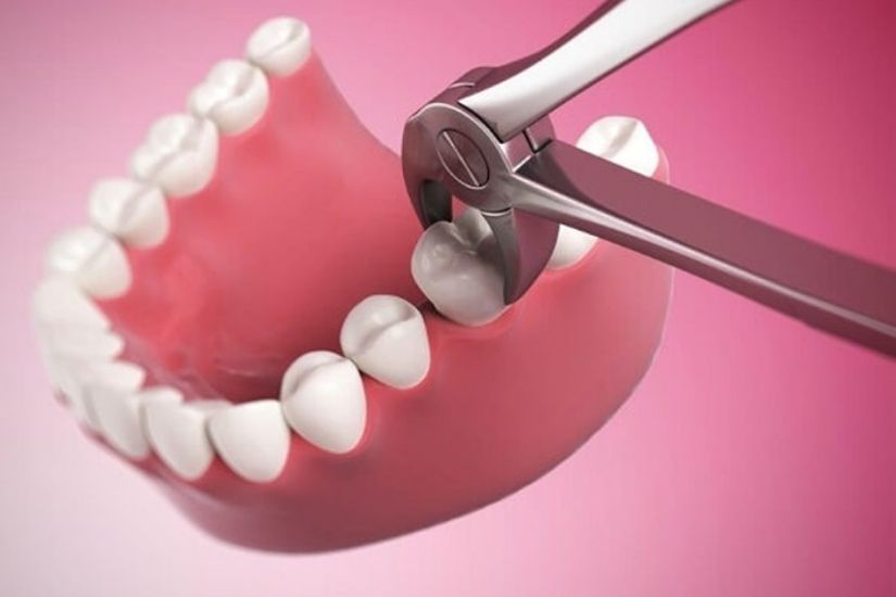Hiểu rõ các rủi ro khi nhổ