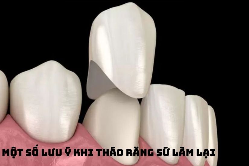 Một số lưu ý khi tháo răng sứ làm lại